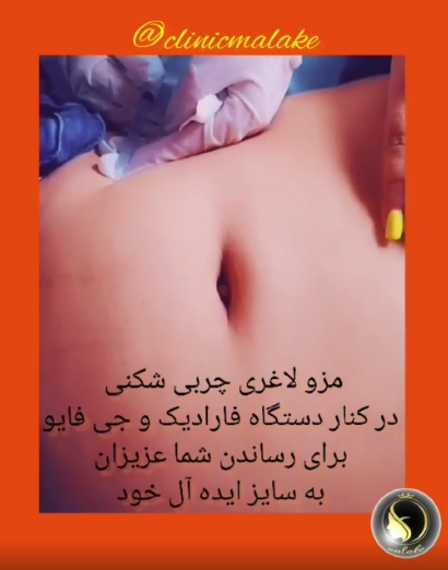 مزو لاغری چربی شکنی